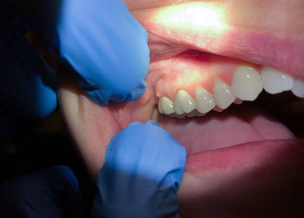 Best Urgent Care for Lost Fillings or Crowns in Vernon Hls, IL